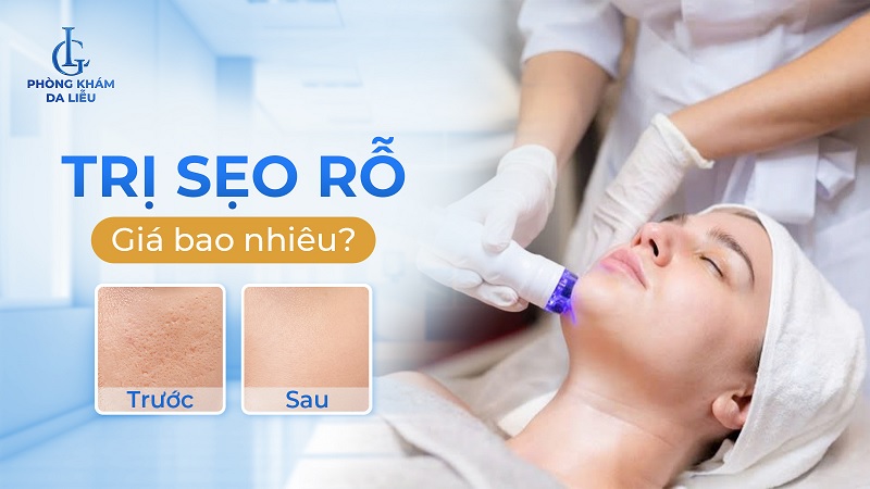 trị sẹo rỗ giá bao nhiêu