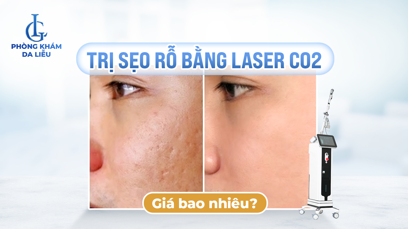 Trị sẹo rỗ bằng laser co2 giá bao nhiêu