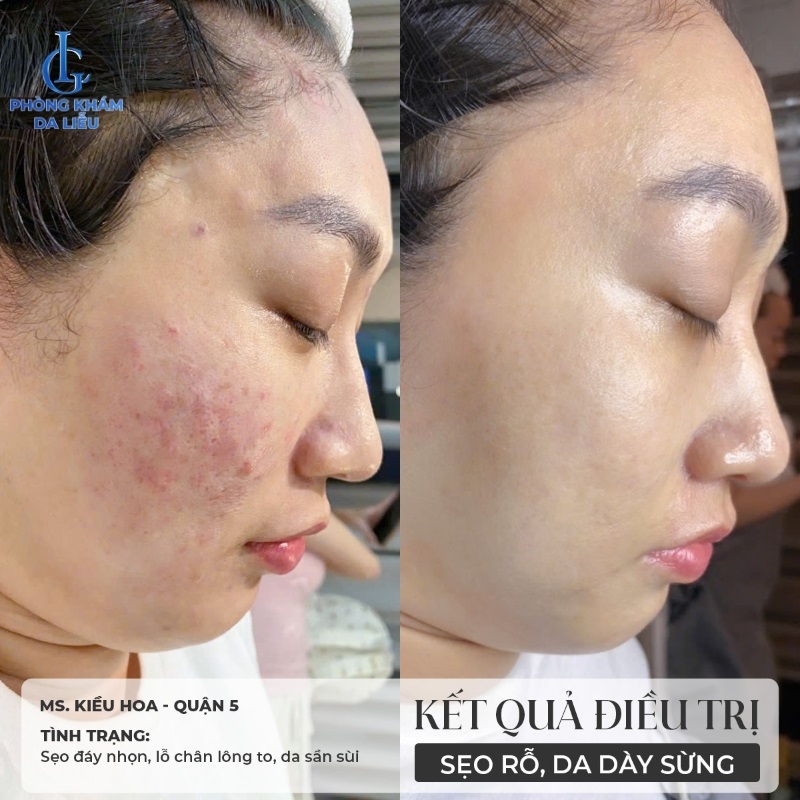 Hình ảnh trước và sau khi trị sẹo rỗ