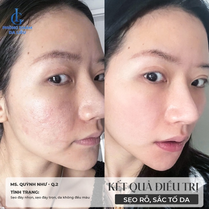 Hình ảnh trước và sau khi trị sẹo rỗ
