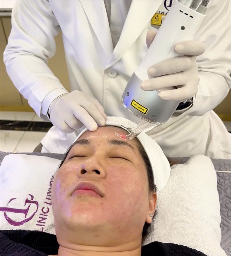 Laser CO2 Fractional trị sẹo