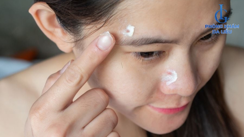 Bôi thuốc trị mụn