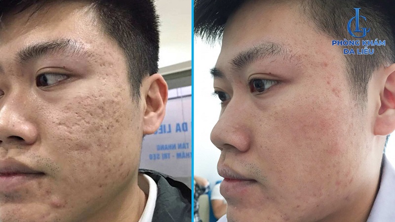 hình ảnh trước và sau khi trị sẹo rỗ trên mặt