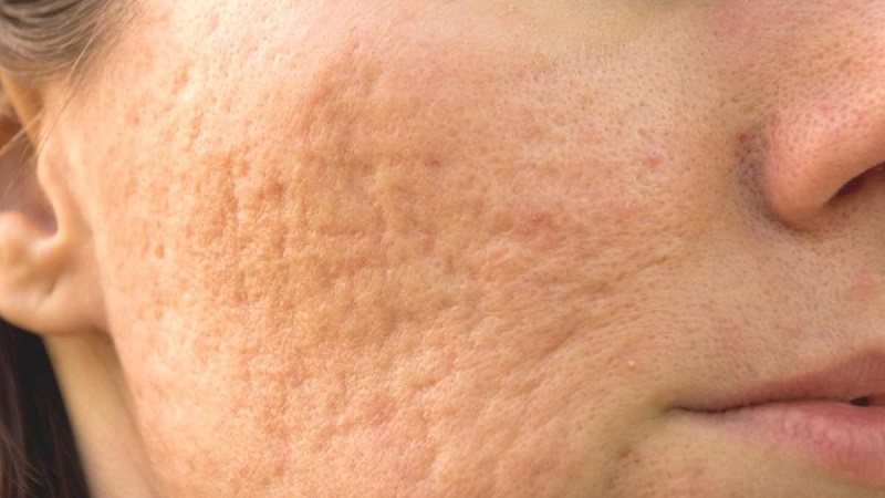 Cách trị sẹo rỗ lâu năm trên mặt tại nhà