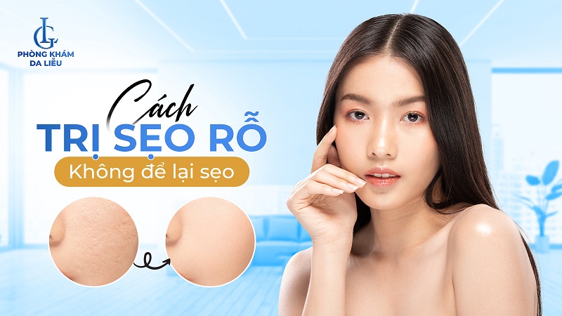 Cách trị sẹo rỗ lâu năm