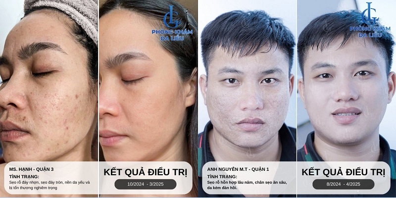 Nơi điều trị sẹo lóm hiệu quả