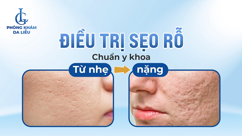 điều trị sẹo rỗ
