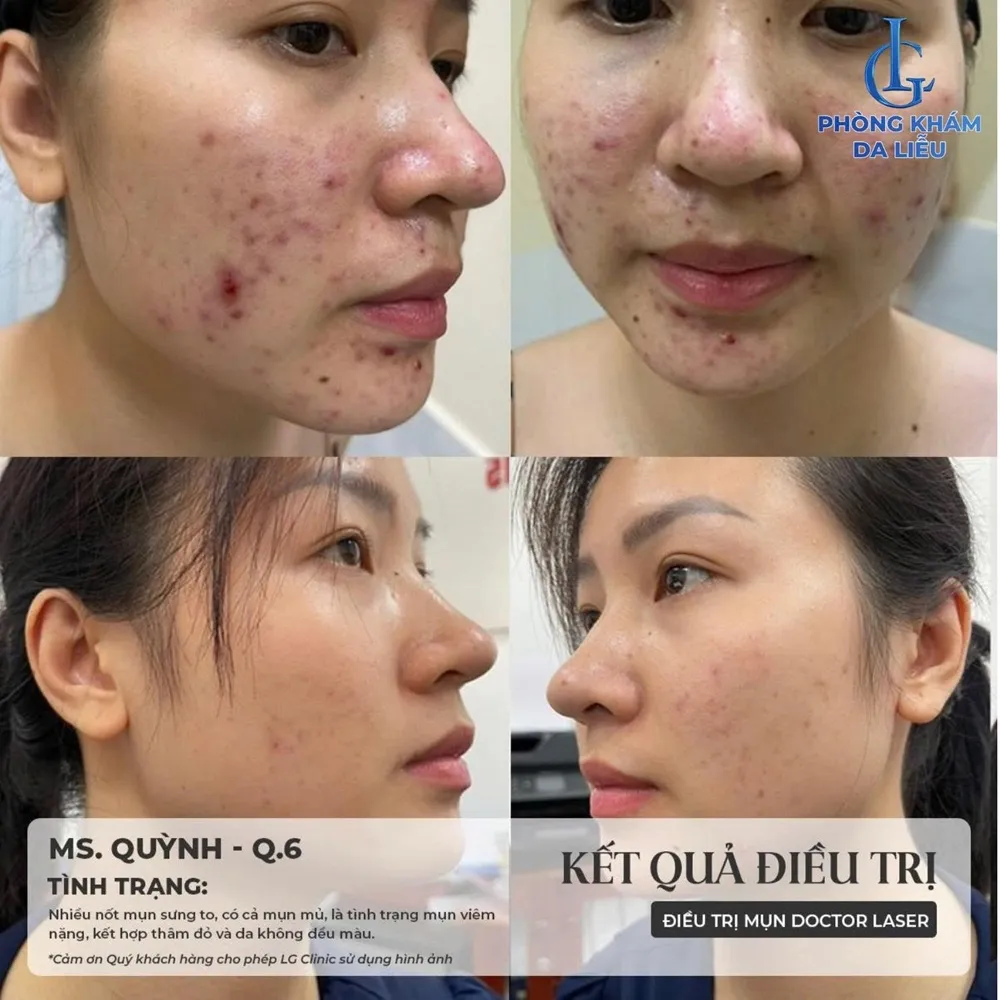 Kết quả điều trị mụn