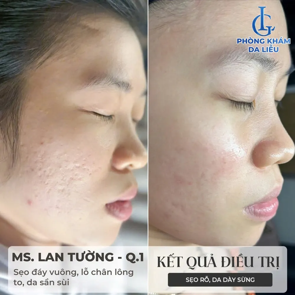 Hình B-A trị sẹo rỗ tại phòng khám LG