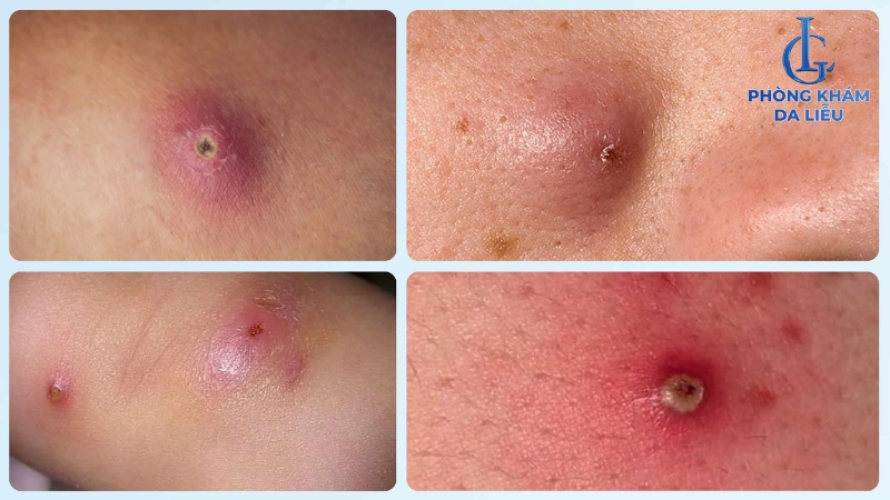 Mụn đinh râu là gì