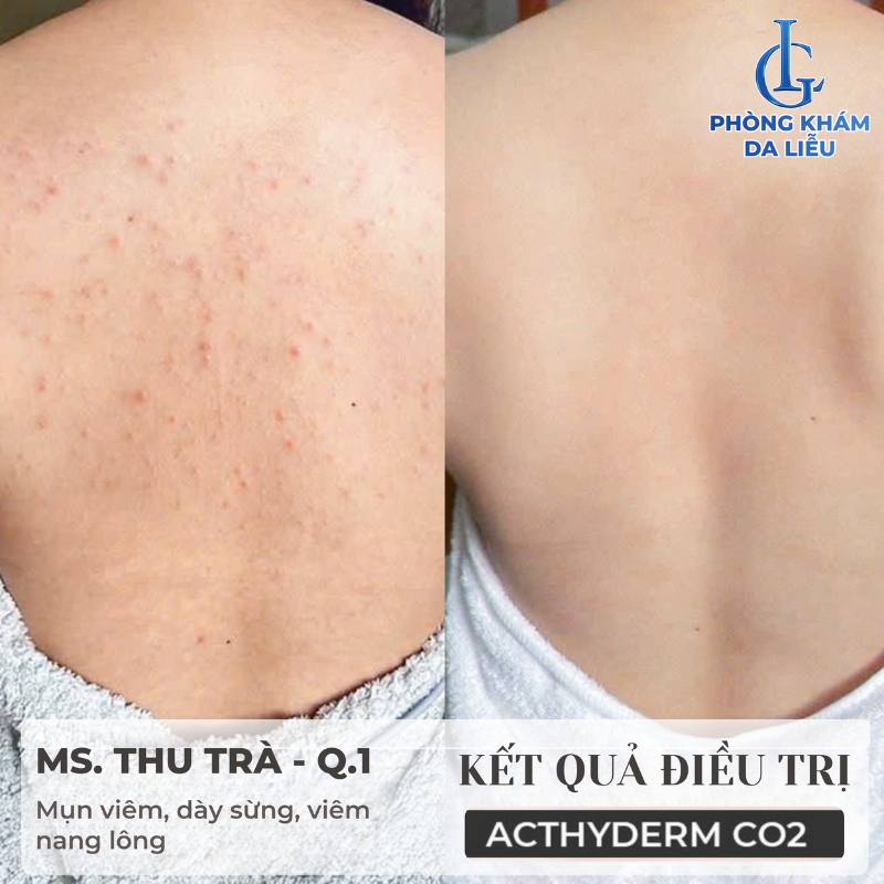 hiệu quả trị mụn lưng