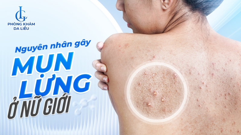 Nguyên nhân gây mụn lưng ở nữ giới
