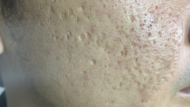 nguyên nhân gây sẹo rỗ