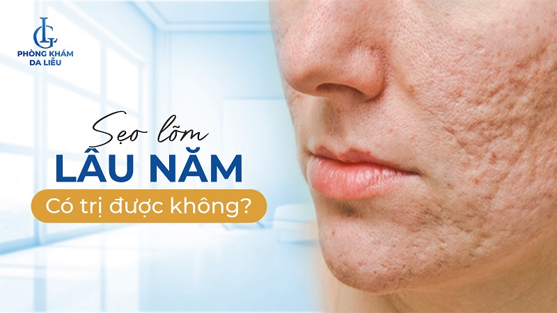 sẹo lọm lâu năm có trị được không