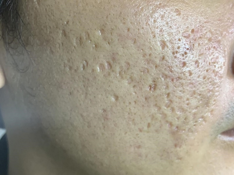 tác hại của sẹo rỗ