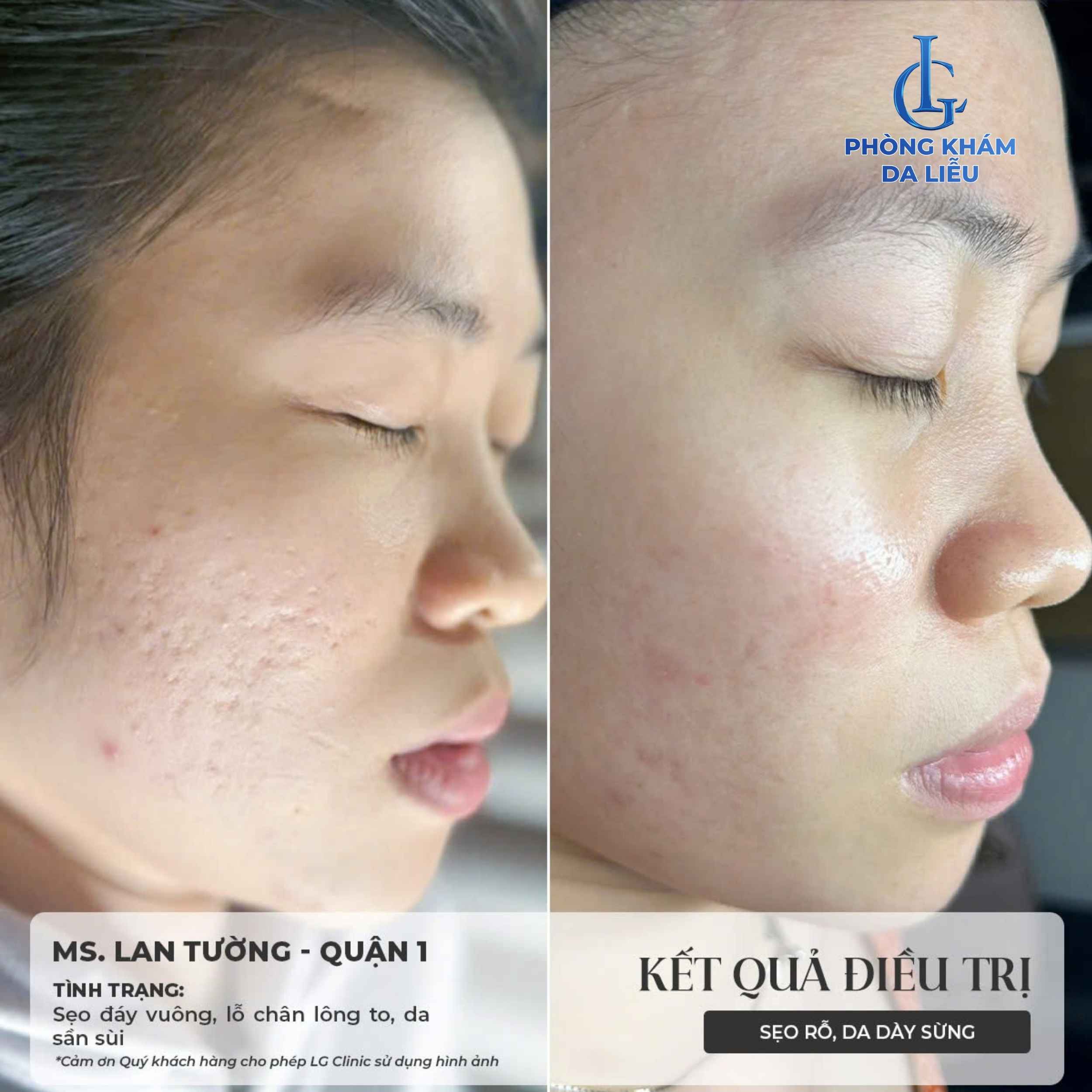 B-A trị sẹo rỗ