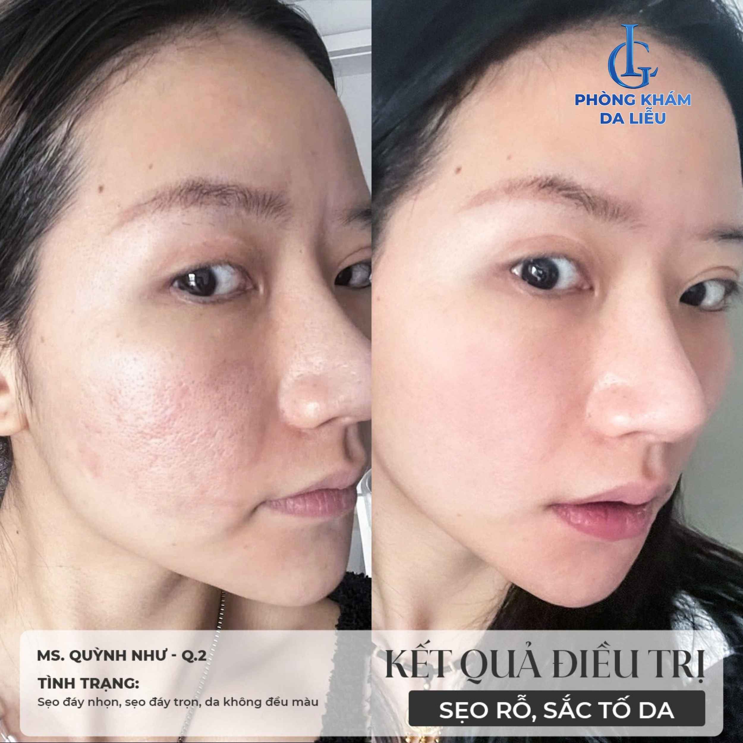 B-A tr ị sẹo rỗ