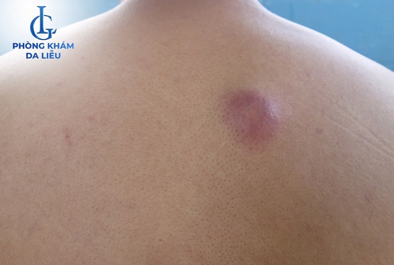 Mụn nhọt ở lưng