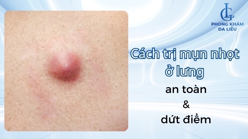 trị mụn nhọt ở lưng​