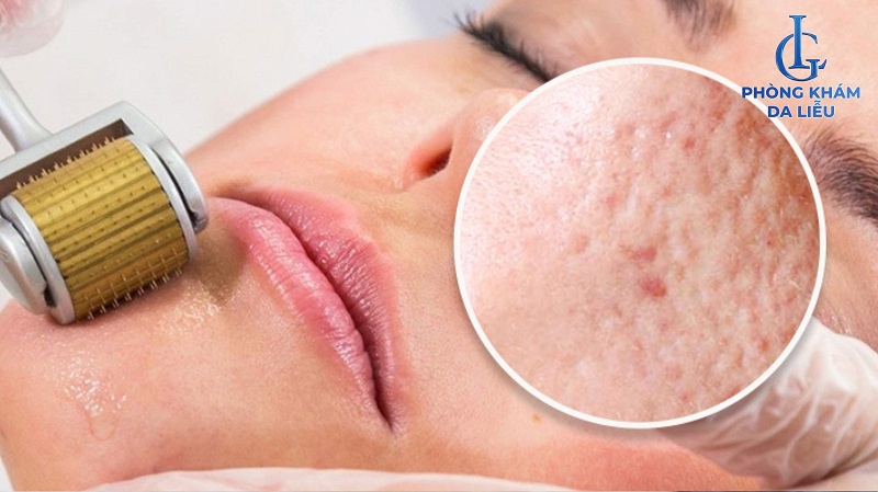 Lăn kim trị sẹo lõm