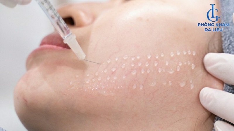 Tiêm collagen làm đầy sẹo lõm