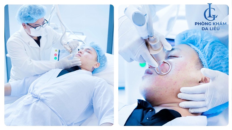 Laser CO2 trị sẹo lõm