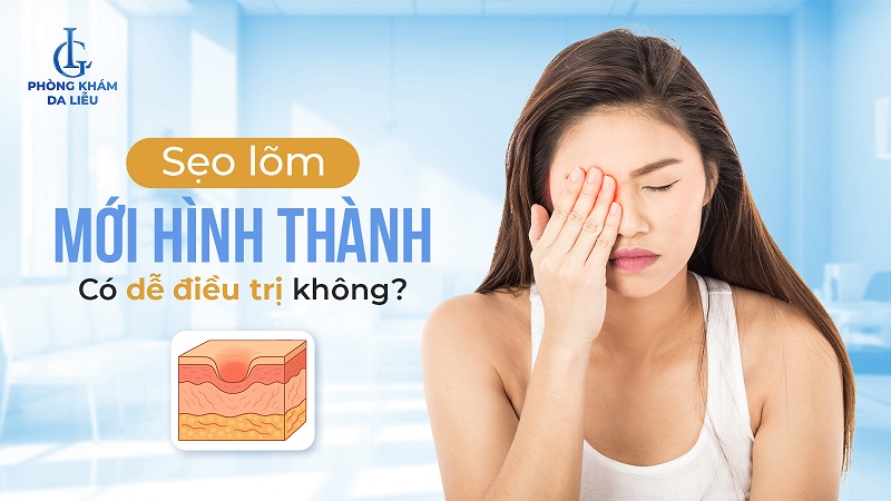 xóa sẹo lõm mới hình thành