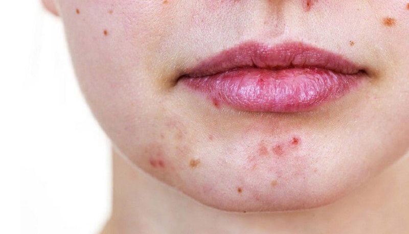 mụn trứng cá mọc xung quanh miệng