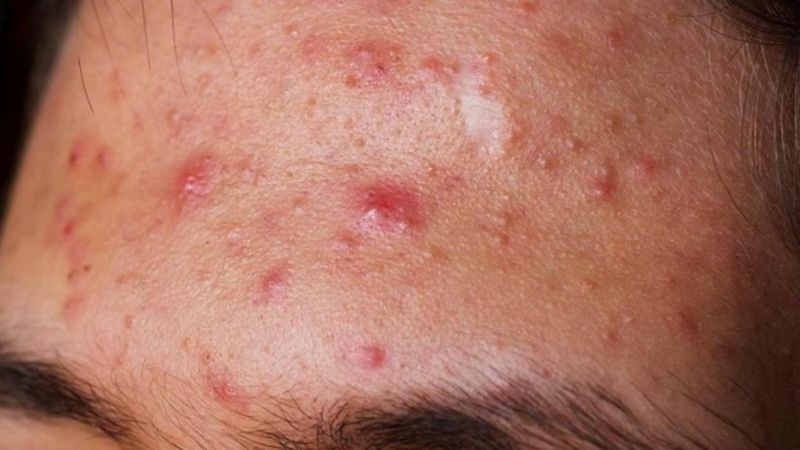 Mụn dị ứng mỹ phẩm là gì?