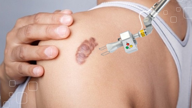 laser trị sẹo lồi