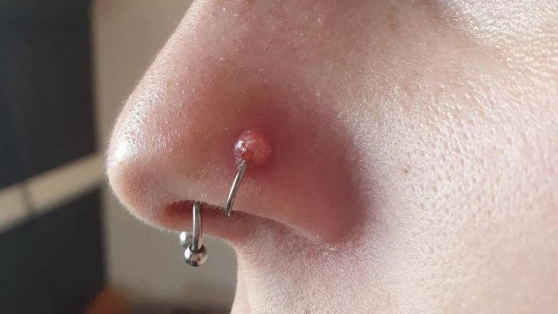 Xỏ khuyên mũi bị sẹo lồi