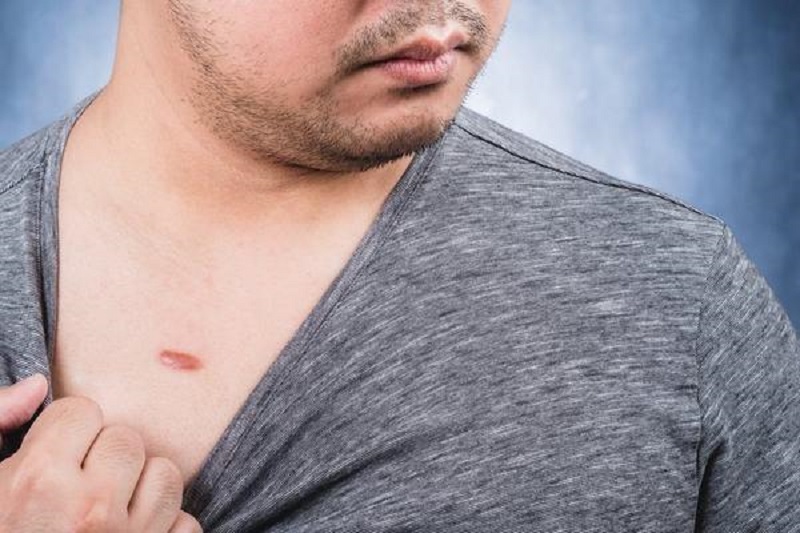 sẹo lồi ở ngực