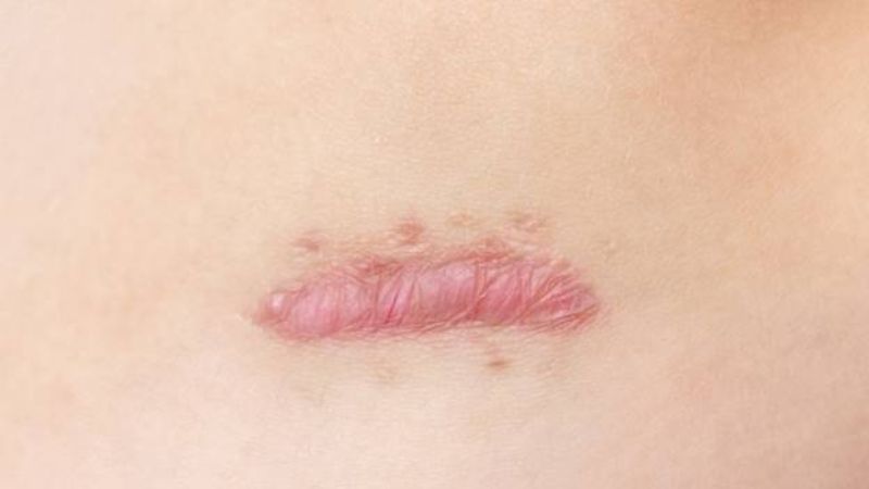 sẹo lồi trước ngực