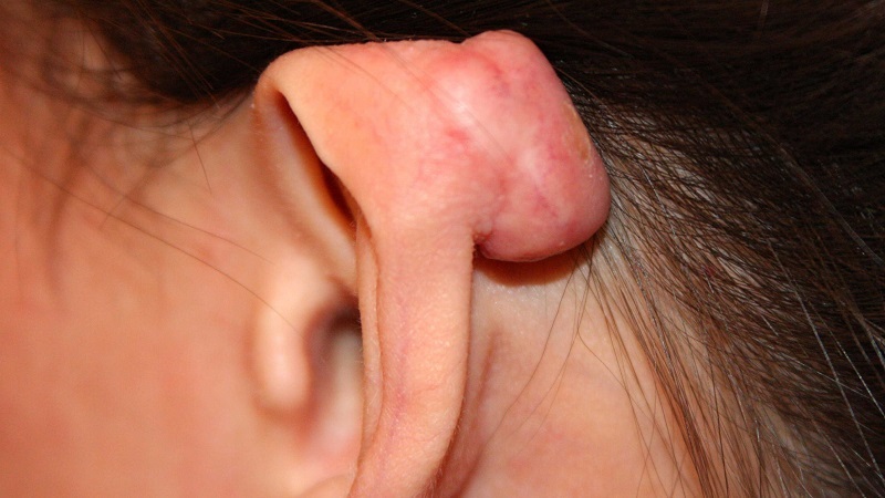 bấm lỗ tại bị sẹo lồi