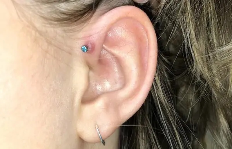 sẹo lồi khi bấm lỗ tai