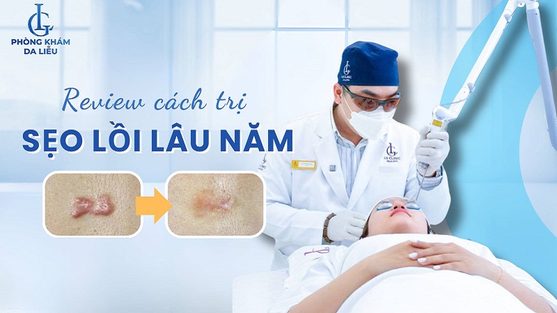 cách trị sẹo lồi lâu năm