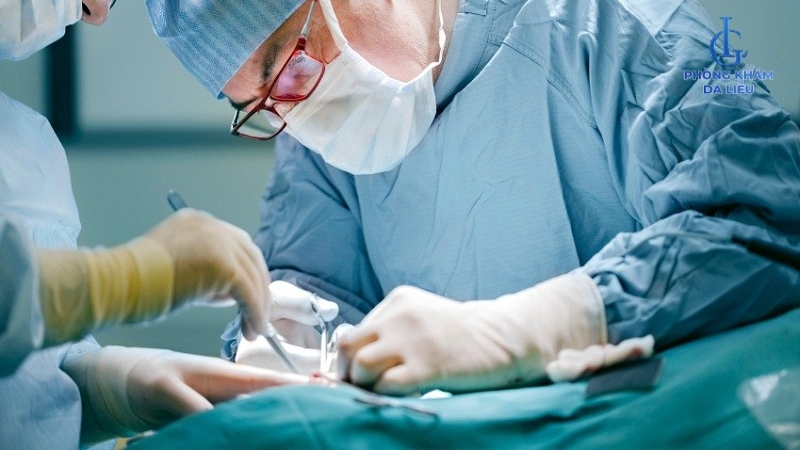 phẫu thuật sẹo lồi