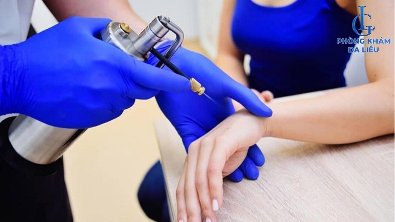 nitơ lỏng điều trị sẹo lồi