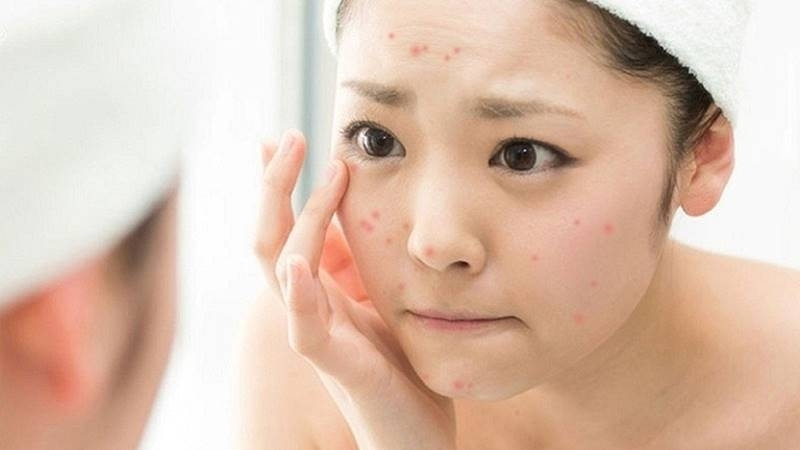 Mụn tái đi tái lại