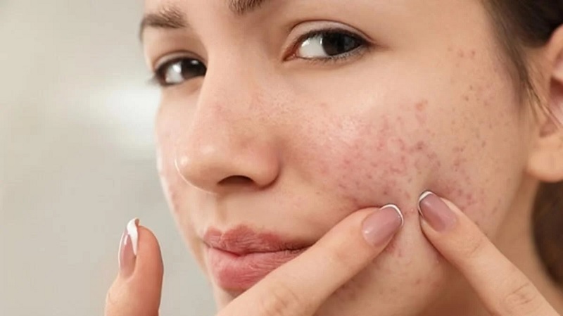 mụn tái đi tái lại một chỗ