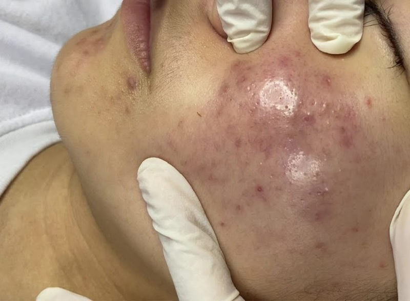 nặn mụn bị tụ máu bầm