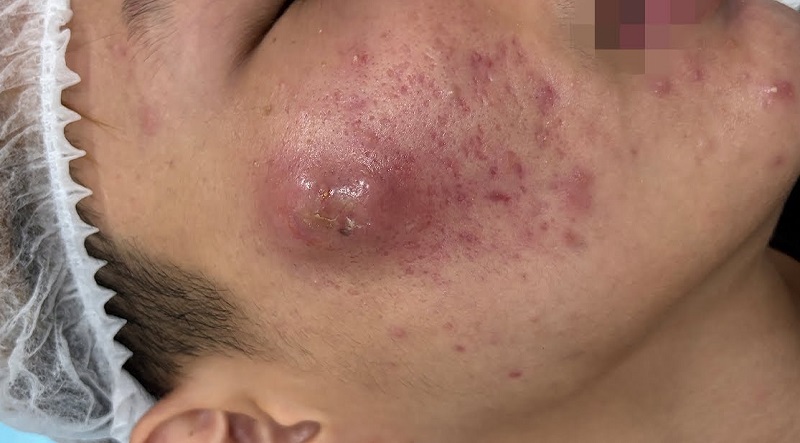 mụn thâm tụ máu có tự hết không