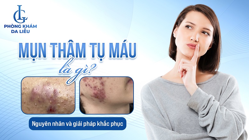Mụn thâm tụ máu