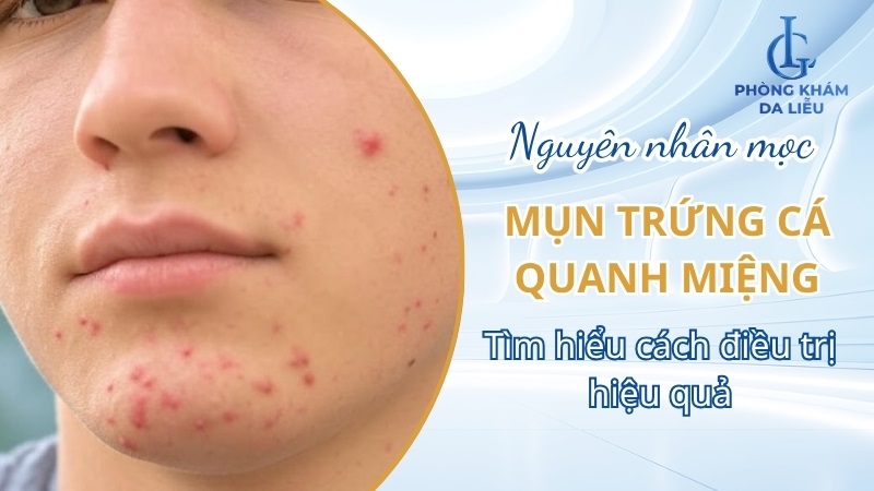 mụn trứng cá mọc quanh miệng