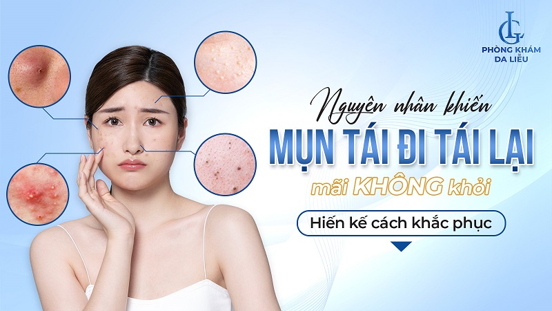 nguyên nhân mụn tái đi tái lại