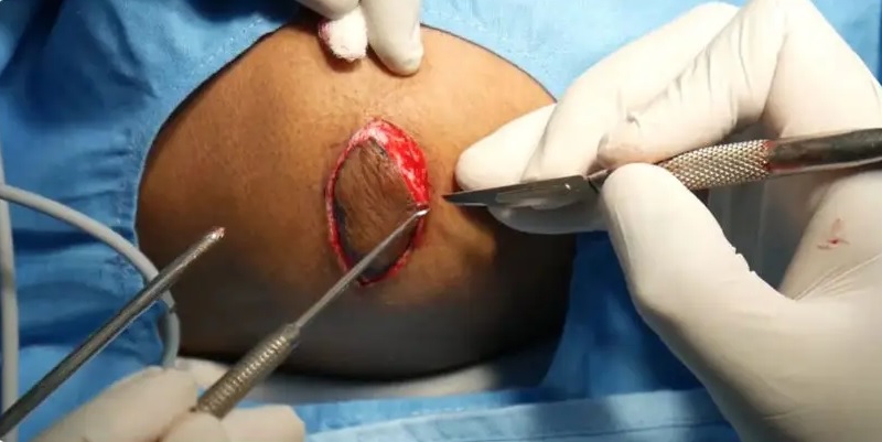 phẫu thuật cắt sẹo lồi