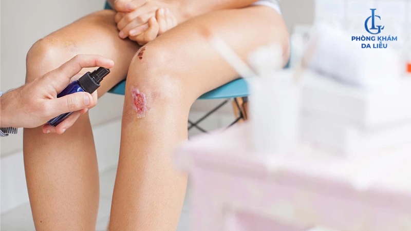 Ngăn ngừa sẹo lồi