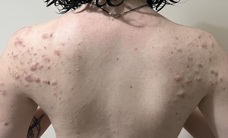 Dấu hiệu nhận biết sớm sẹo lồi tự nổi