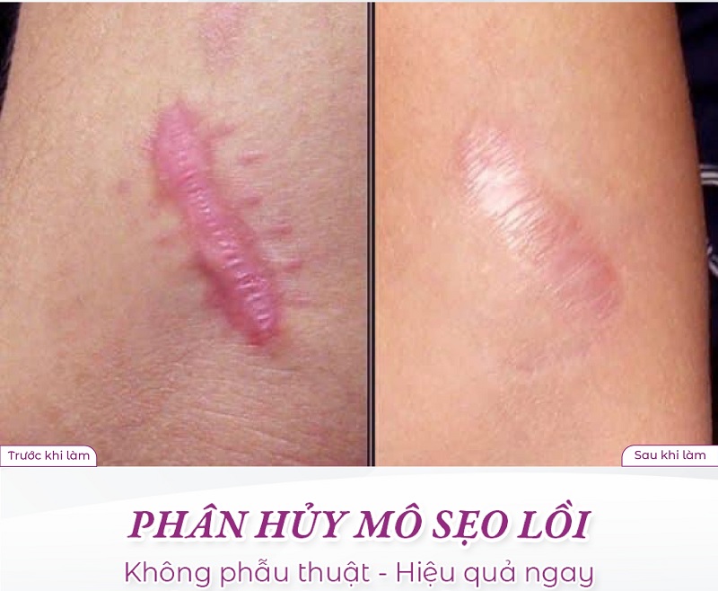 hình ảnh trước và sau khi điều trị sẹo lồi
