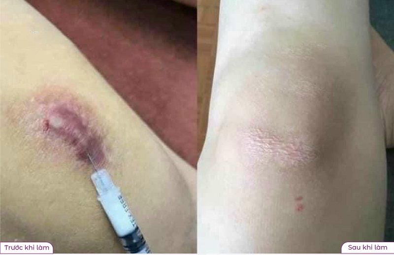 hình ảnh trước và sau khi điều trị sẹo lồi